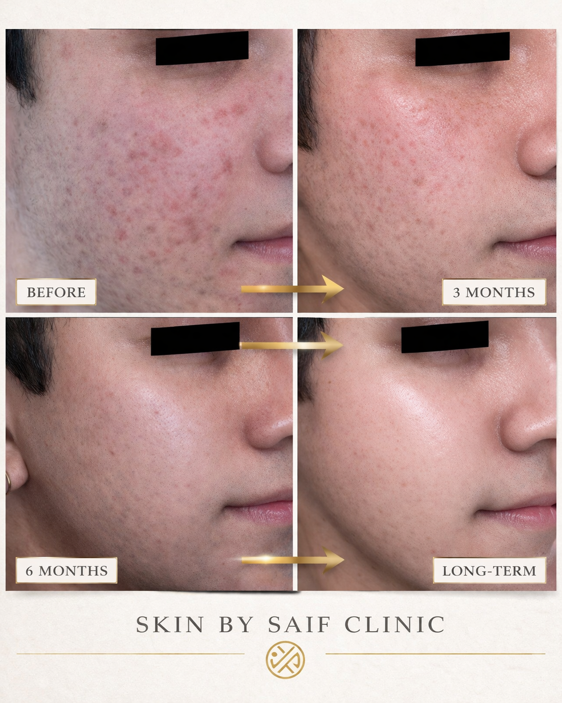 Before and after acne skin journey results